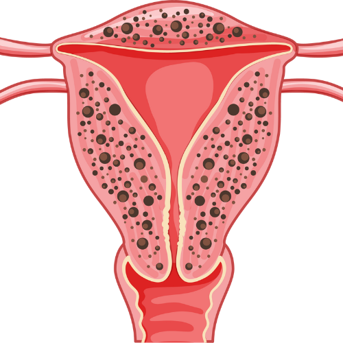 Endometriosis: Adenomyosis